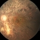 Stargardt’s disease Stargardt’s disease