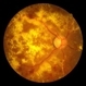 Diabetic Retinopathy Hard Exudates OD
