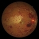 CRVO Combined With Branch Retinal Artery Occlusion