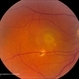 Central Serous Retinopathy with Fibrin
