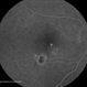 Central Serous Retinopathy with Fibrin - Early-phase FA