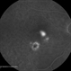 Central Serous Retinopathy with Fibrin - Mid-phase FA