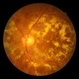 Diabetic Retinopathy Hard Exudates OS Diabetic Retinopathy Hard Exudates OS