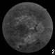 Diabetic Retinopathy Hard Exudates OD Diabetic Retinopathy Hard Exudates OD