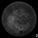 Diabetic Retinopathy Hard Exudates OS Diabetic Retinopathy Hard Exudates OS