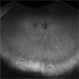 Plate-lens Dislocation Plate-lens Dislocation