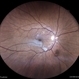 Branch Retinal Artery Occlusion Branch Retinal Artery Occlusion