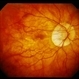 Peripapillary Atrophy With High Myopia Peripapillary Atrophy With High Myopia