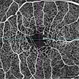Macular Telangiectasia Type 2 Macular Telangiectasia Type 2