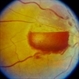 Subhyaloid Haemorrhage