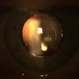 Medium Well-Centered Capsulorrhexis With Complete Gas Fill Medium Well-Centered Capsulorrhexis With Complete Gas Fill