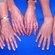 Hands of 3 generations of a Marfan's family Hands of 3 generations of a Marfan's family
