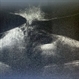 Vitreopapillary Traction-Volcanic Eruption