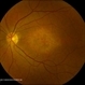 Central Areolar Choroidal Dystrophy