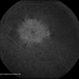 Central Areolar Choroidal Dystrophy