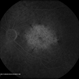 Central Areolar Choroidal Dystrophy
