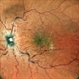 Hypotonous Maculopathy Hypotonous Maculopathy