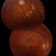 Retinal Hemangioblastoma Retinal Hemangioblastoma