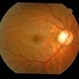 Bilateral Myopic Foveoschisis