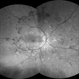Proliferative Diabetic Retinopathy- Red free Proliferative Diabetic Retinopathy- Red free