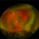 Limited Choroidal Hemorrhage S/P Glaucoma Valve Implant OS;  Retinoschisis Limited Choroidal Hemorrhage S/P Glaucoma Valve Implant OS;  Retinoschisis