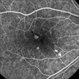 Punctate Inner Choroidopathy with CNV Treated with Bevacizumab # 4 of 7 Punctate Inner Choroidopathy with CNV Treated with Bevacizumab # 4 of 7