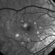 Punctate Inner Choroidopathy with CNV Treated with Bevacizumab # 2 of 7 Punctate Inner Choroidopathy with CNV Treated with Bevacizumab # 2 of 7