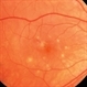 Punctate Inner Choroidopathy with CNV Treated with Bevacizumab # 1 of 7 Punctate Inner Choroidopathy with CNV Treated with Bevacizumab # 1 of 7