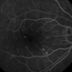 Punctate Inner Choroidopathy with CNV Treated with Bevacizumab # 3 of 7 Punctate Inner Choroidopathy with CNV Treated with Bevacizumab # 3 of 7