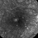 Punctate Inner Choroidopathy with CNV Treated with Bevacizumab # 5 of 7 Punctate Inner Choroidopathy with CNV Treated with Bevacizumab # 5 of 7
