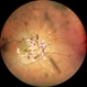 RE WIDEFIELD FUNDUS PHOTOGRAPH OF HYPERTENSIVE RETINOPATHY GRADE IV
