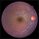 Congenital Retinal Vessel Tortuosity