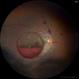 Valsalva Retinopathy Valsalva Retinopathy