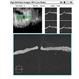 Asymptomatic Superior Retinal Detachment