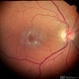 Macular Telangiectasia Type 2 Macular Telangiectasia Type 2