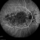 Persistent Placoid Maculopathy Persistent Placoid Maculopathy