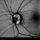 Drusen of Optic Disc Drusen of Optic Disc