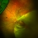 Widefield Infant with Congenital Coloboma Widefield Infant with Congenital Coloboma