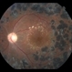 Retinal Crystals with History of Intravitreal  Triamcinolone Retinal Crystals with History of Intravitreal  Triamcinolone