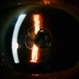 Vitreous in AC Vitreous in AC