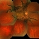 Pigmentary Paravenous Retinochoroidal Atrophy (Right Eye) Pigmentary Paravenous Retinochoroidal Atrophy (Right Eye)