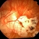 High Myopia