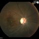 Choroidal Hemorrhage from Hypertensive  Choroidopathy Choroidal Hemorrhage from Hypertensive  Choroidopathy