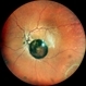 Vitreous Cyst Vitreous Cyst