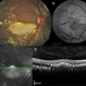 Macular Edema