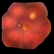 Choroidal Metastasis Choroidal Metastasis