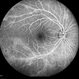 Possible Uveitis or RP Variant Possible Uveitis or RP Variant