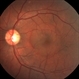 Central Serous Choroidopathy, CSR, with Foci of Leakage