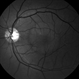 Central Serous Choroidopathy, CSR, with Foci of Leakage