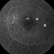 Central Serous Choroidopathy, CSR, with Foci of Leakage
